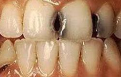 لتجنب تسوس الأسنان 3 نصائح ضرورية للتعامل مع كسورها