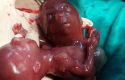 إجراء عملية إجهاض لسيدة حامل فى طفل برأسين ورقبتين فى جسد واحد