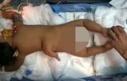 بالصور.. جراحة ناجحة لطفلة هندية ولدت بـ3 أرجل