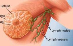 يمكن التخلص منها بالشفط.. 85% من الأورام التى تتحسسها المرأة بالثدى حميدة