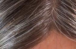استشارى جلدية: اكتشاف الجين المسبب للشيب يبشر باختفاء الشعر الأبيض