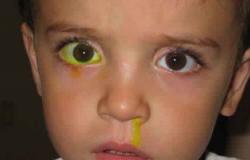 أعراض انسداد القناة الدمعية عند طفلك.. تعرف عليها