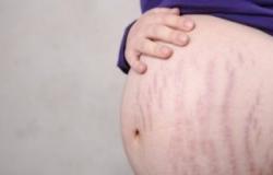 3 علاجات منزلية للتغلب على علامات تمدد الجلد أثناء الحمل