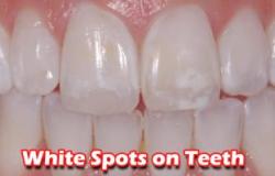 4 أسباب تؤدى لظهور بقع بيضاء على الأسنان "احذرها"