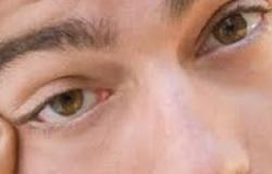 أستاذ عيون: عالج ضبابية العين بالقطرات المرطبة بعد عمليات الليزك